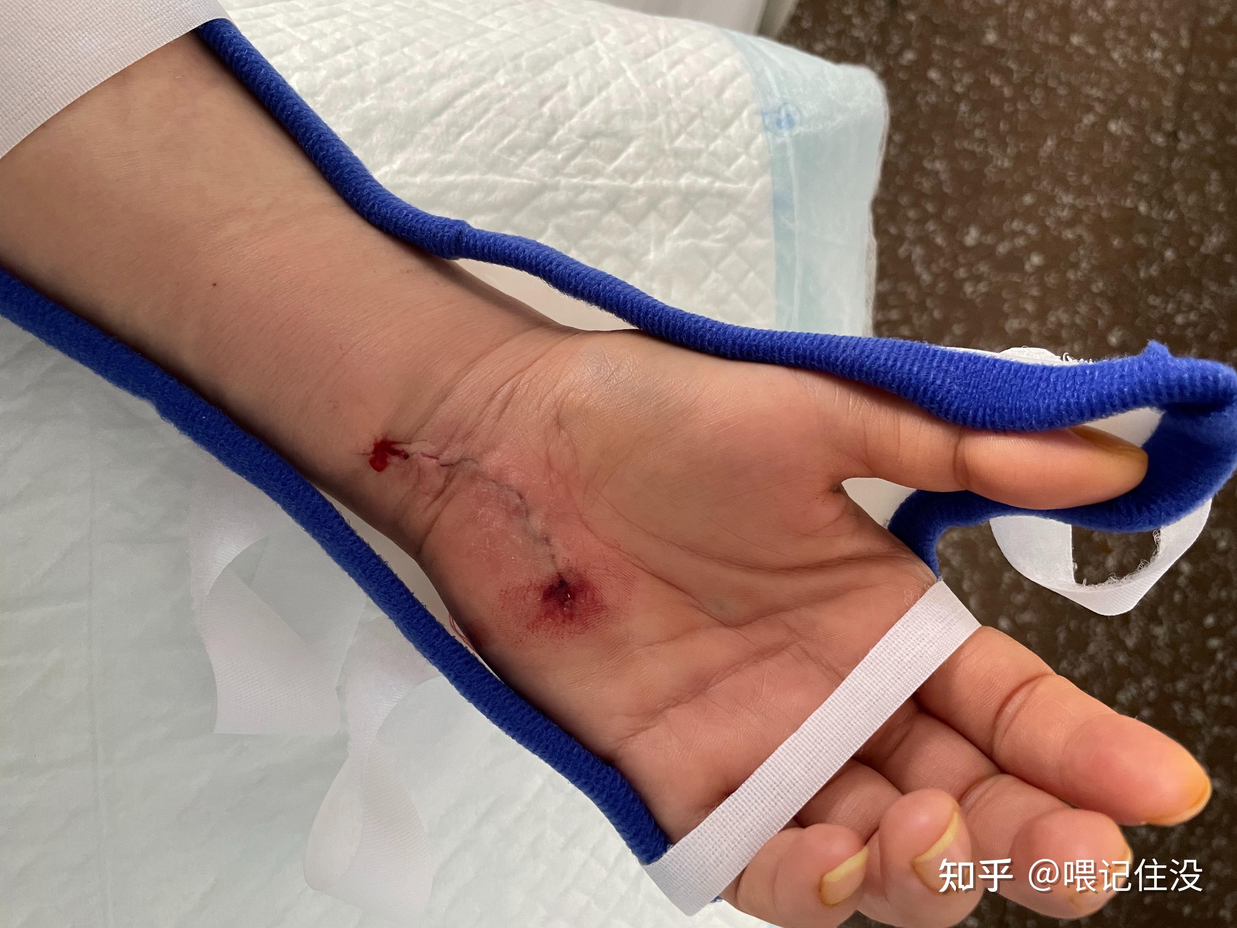 阿里健康拿下贝捷迈®全国首发 系中国首个腱鞘巨细胞瘤(TGCT)口服新药